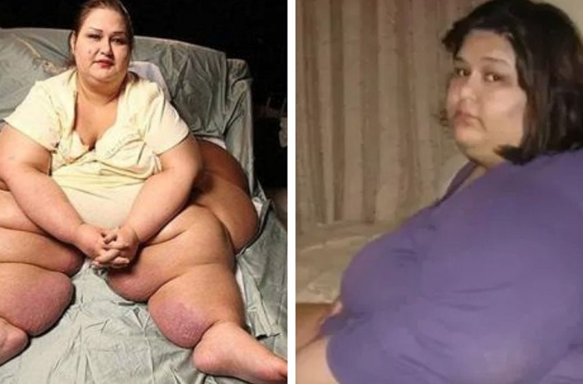  Женщина, весившая почти 500 кг, изменилась после несчастного случая