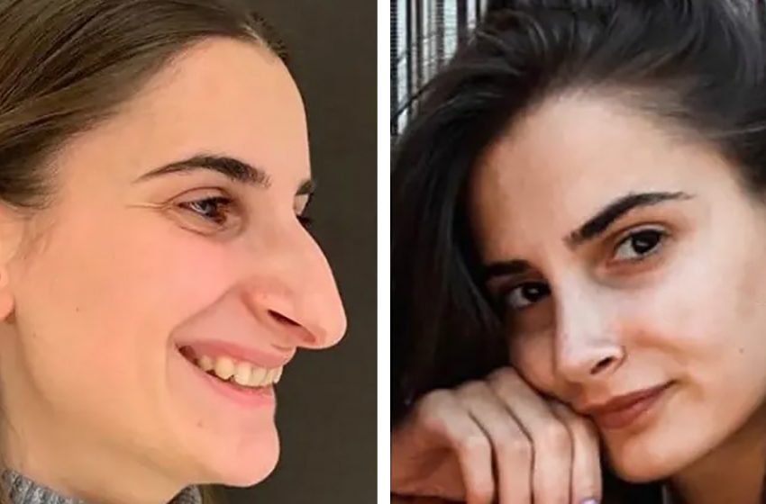  «Разница на лицо»: Как ринопластика меняет внешность людей