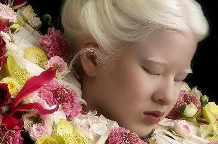  «Белая королева»: Как сложилась судьба девочки — альбиноса из Китая, от которой отказалась ее семья