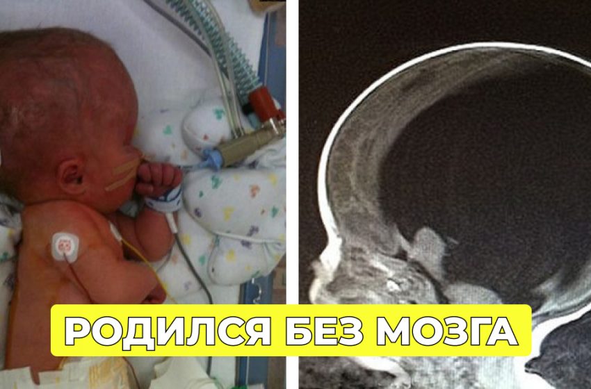  «Как такое может быть?»: как выглядит мальчик, который родился без мозга, но сумел удивить врачей во всем мире