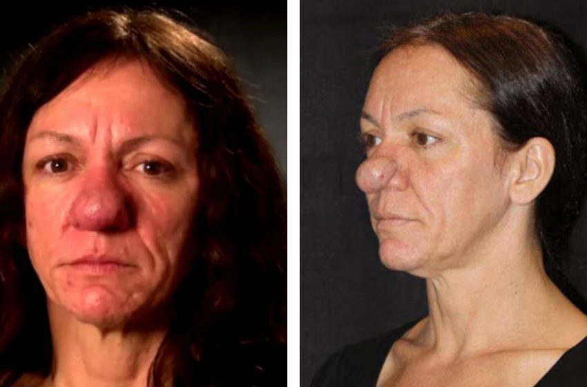  «Стала настоящей красоткой!»: Женщина с большим из-за редкого заболевания носом решилась на пластику