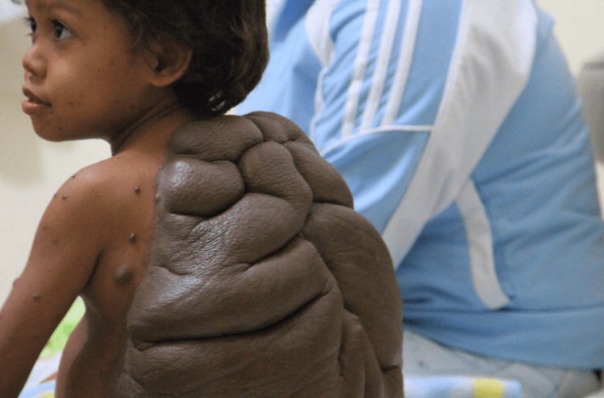  Что случилось с «мальчиком — черепахой» из Колумбии, у которого родинка образовала панцирь на его спине