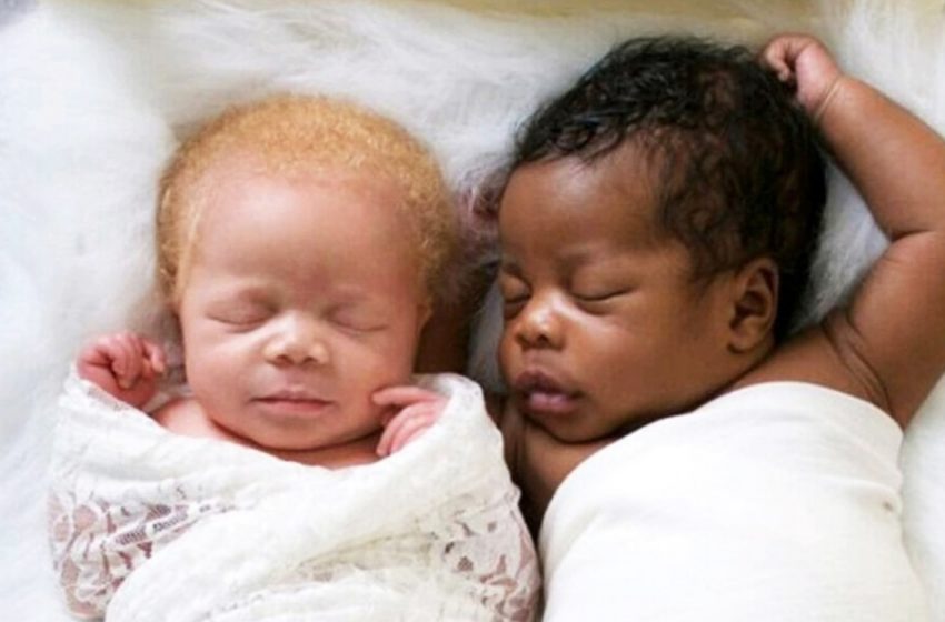  Очень разные, но такие одинаковые: Как сейчас выглядят близнецы, один из которых родился альбиносом