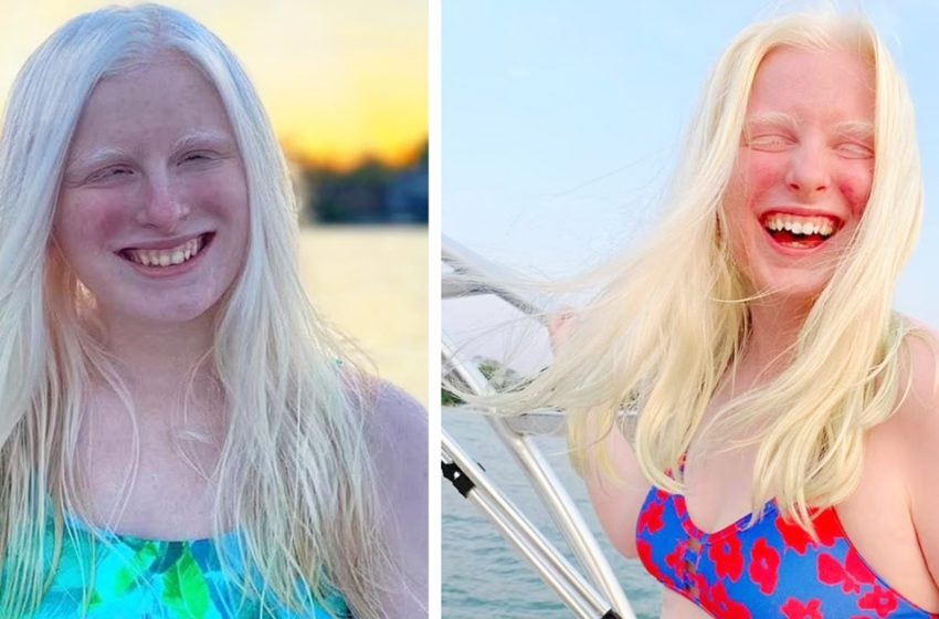  Будто два сапфира: Девушка — альбинос показала впервые за долгое время цвет своих глаз